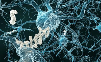 Alzheimers